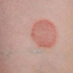 Розовый лишай на коже человека