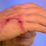 в каких случаях делают прививку от бешенства человеку