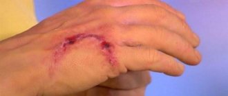 в каких случаях делают прививку от бешенства человеку
